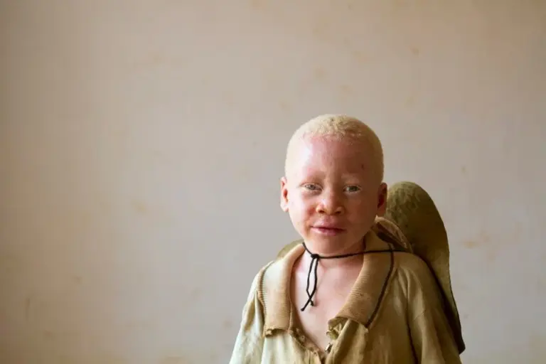 Burundi : les restes d’un albinos de 4 ans, assassiné et démembré, découverts dans la forêt